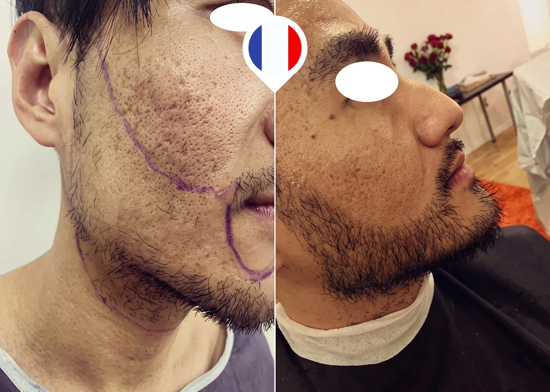 Patchy cheeks and mustache-to-beard connection