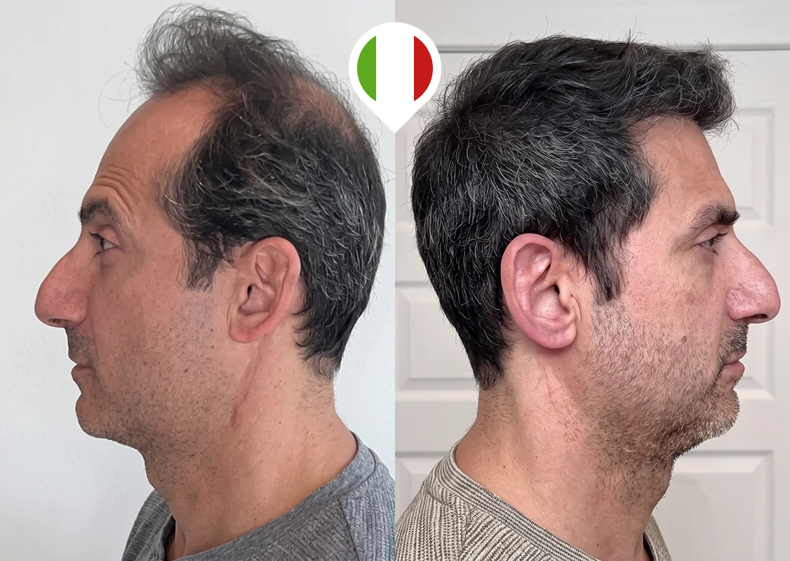 Receding hairline and top-of-scalp density restoration