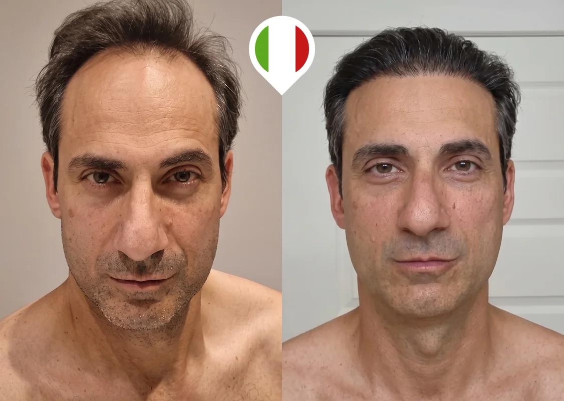 Receding hairline and top-of-scalp density restoration