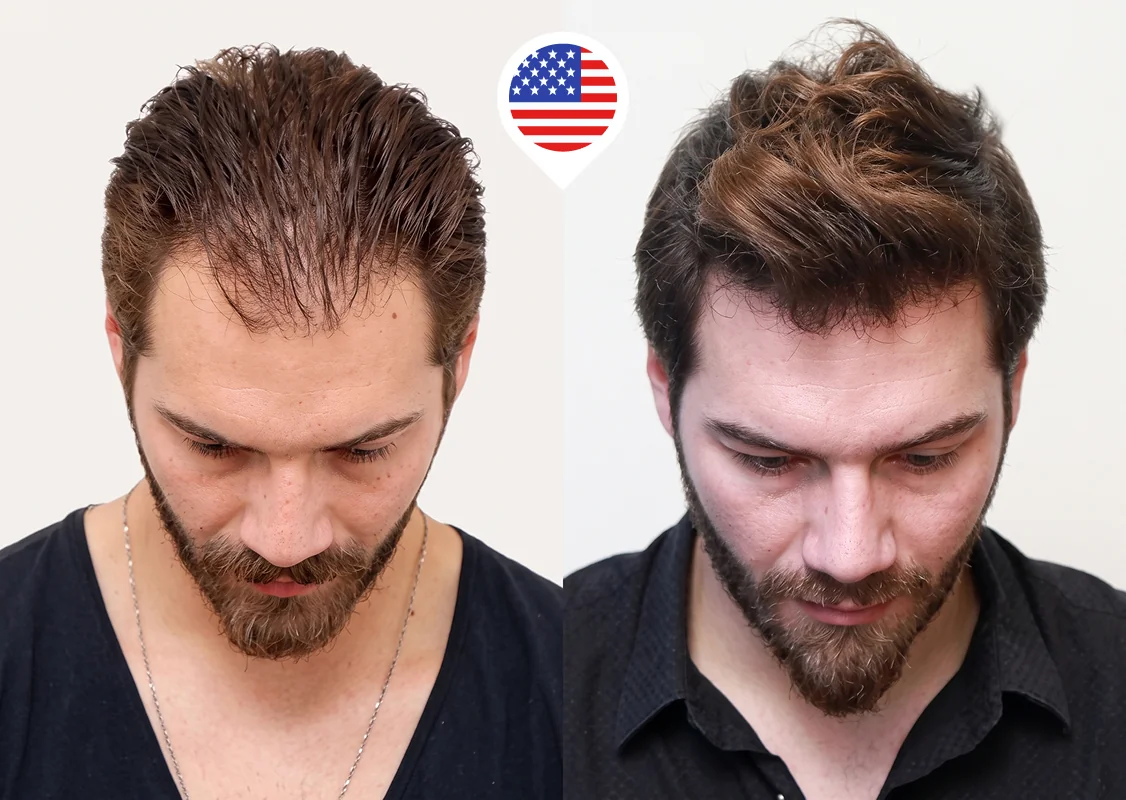 Frontal and mid-scalp diffuse thinning restoration