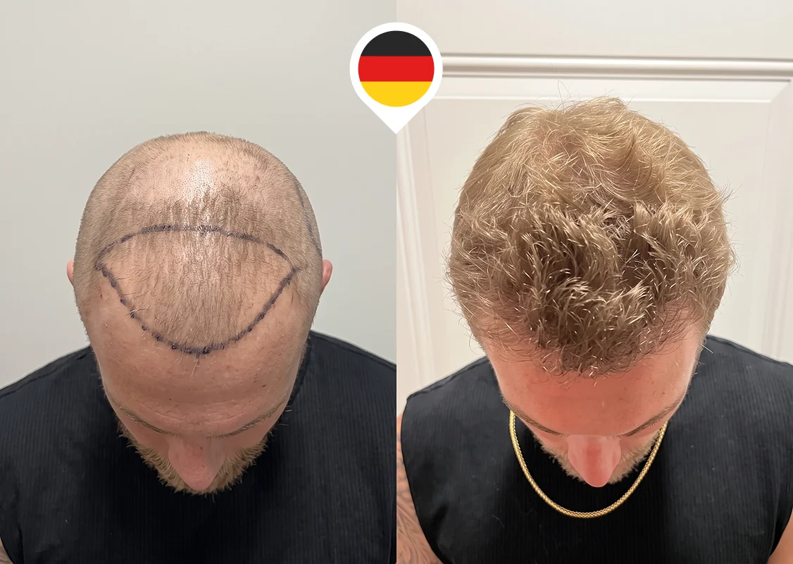 Frontal third and forelock restoration