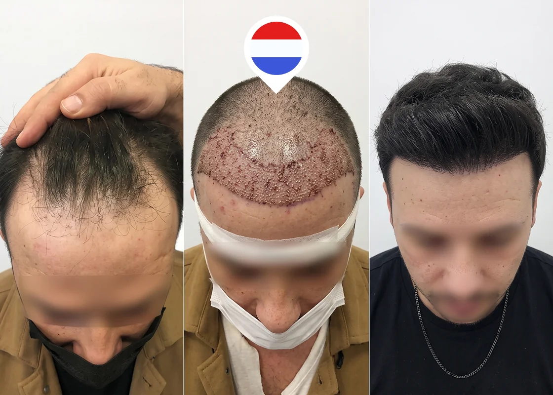 Receding hairline and frontal zone restoration