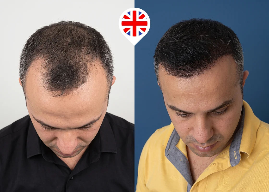 Frontal zone, temples and mid-scalp restoration