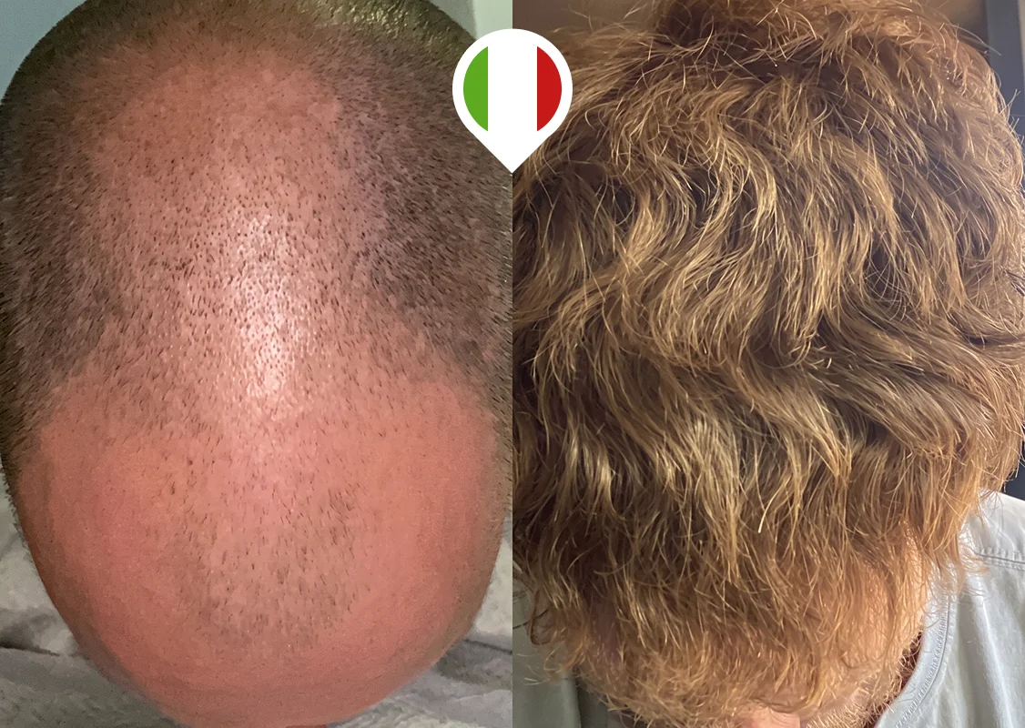 Crown and mid-scalp baldness restoration