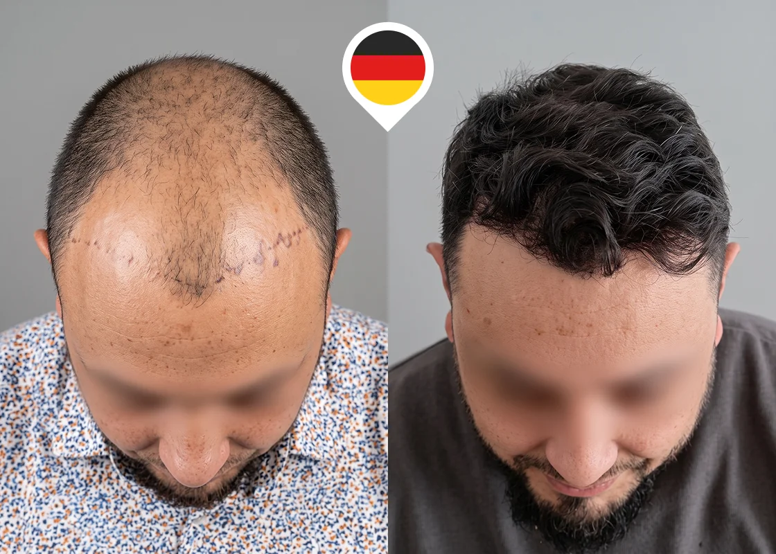 Advanced frontal and mid-scalp baldness restoration