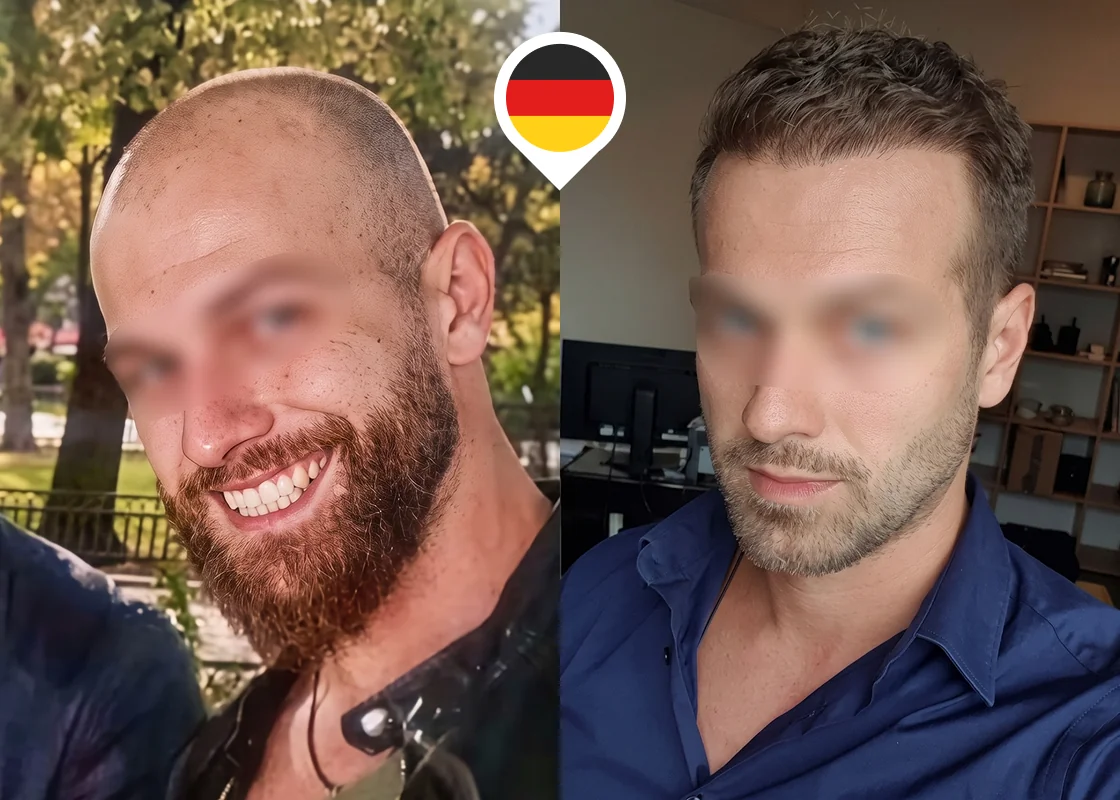 Advanced baldness: full top-of-scalp restoration