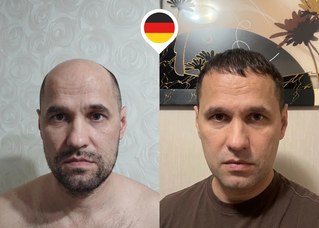 Bald top of scalp restoration with natural hairline