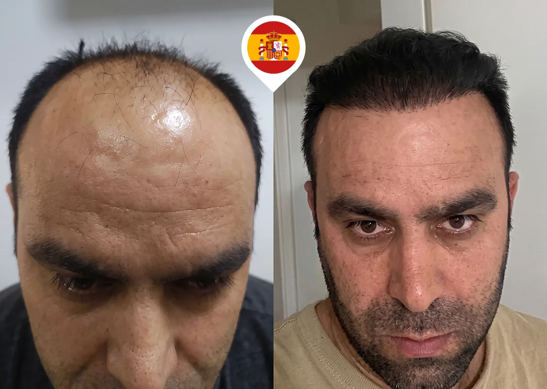 Bald frontal zone and mid-scalp full coverage