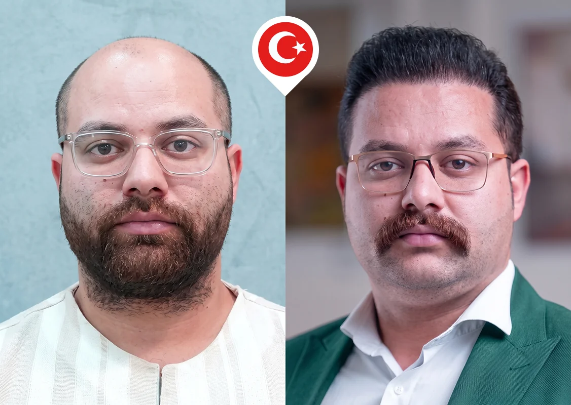 Complete top-of-scalp restoration for advanced baldness